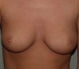 Case--8763 | Before Breast Augmentation