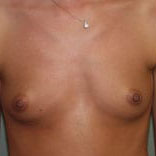 Case--1107 | Before Breast Augmentation