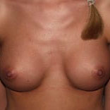 Case--1107 | After Breast Augmentation