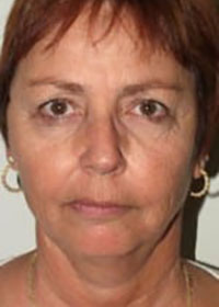 Case--1307 | Before Facelift