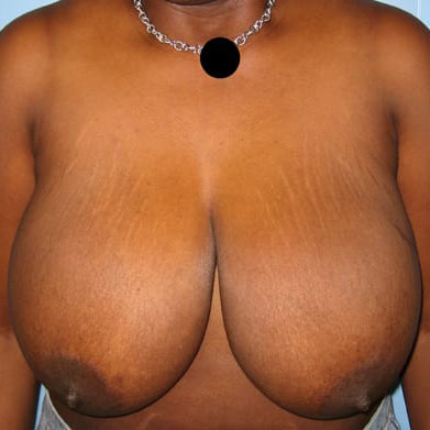 Case--9396 | Before Breast Lift & Breast Reduction