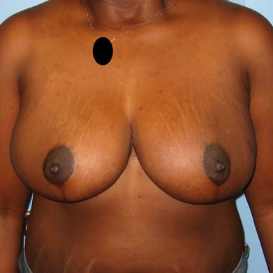 Case--9396 | After Breast Lift & Breast Reduction