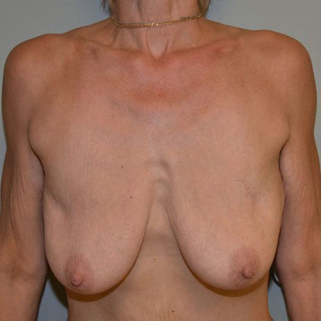 Case--5637 | Before Breast Lift & Breast Reduction