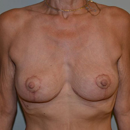 Case--5637 | After Breast Lift & Breast Reduction