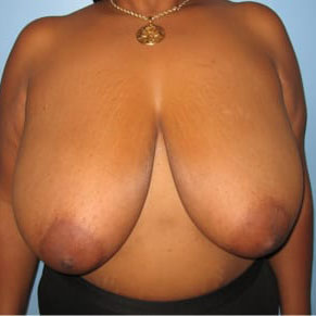 Case--8225 | Before Breast Lift & Breast Reduction