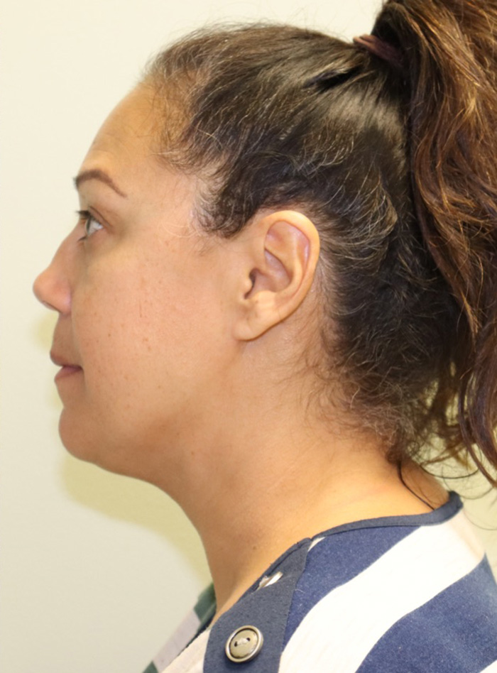 Case--6028 | After Liposuction