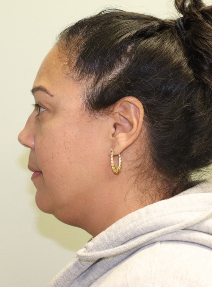 Case--6028 | Before Liposuction