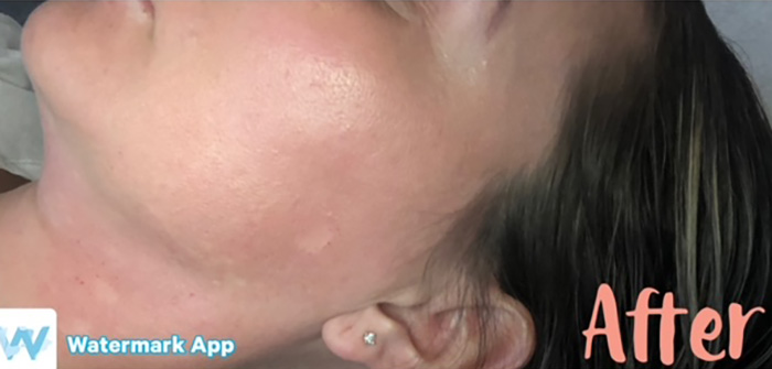 Case--2340 | After Peels, Facials and Microneedling