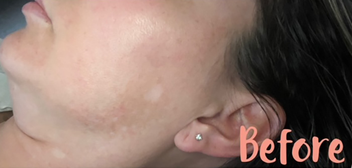 Case--2340 | Before Peels, Facials and Microneedling