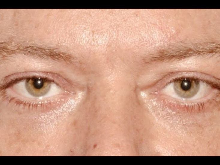 Eyelid lift patient 2474 After