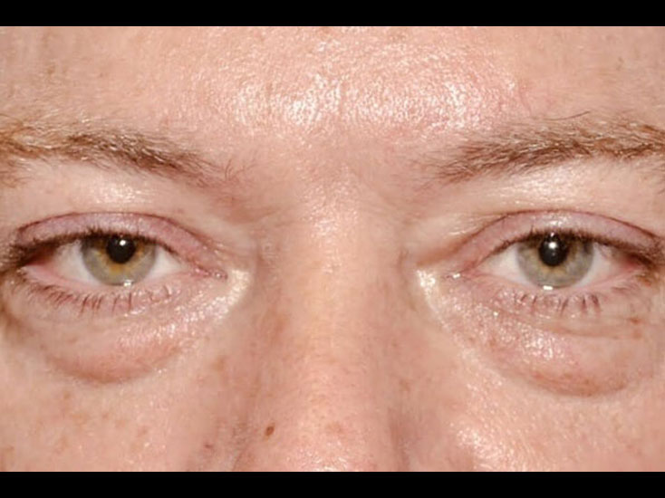 Eyelid lift patient 2474 Before