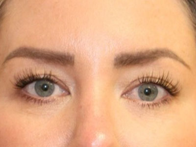 Case--2319 | After Eyelid & Brow Surgery