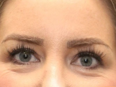 Case--2319 | Before Eyelid & Brow Surgery