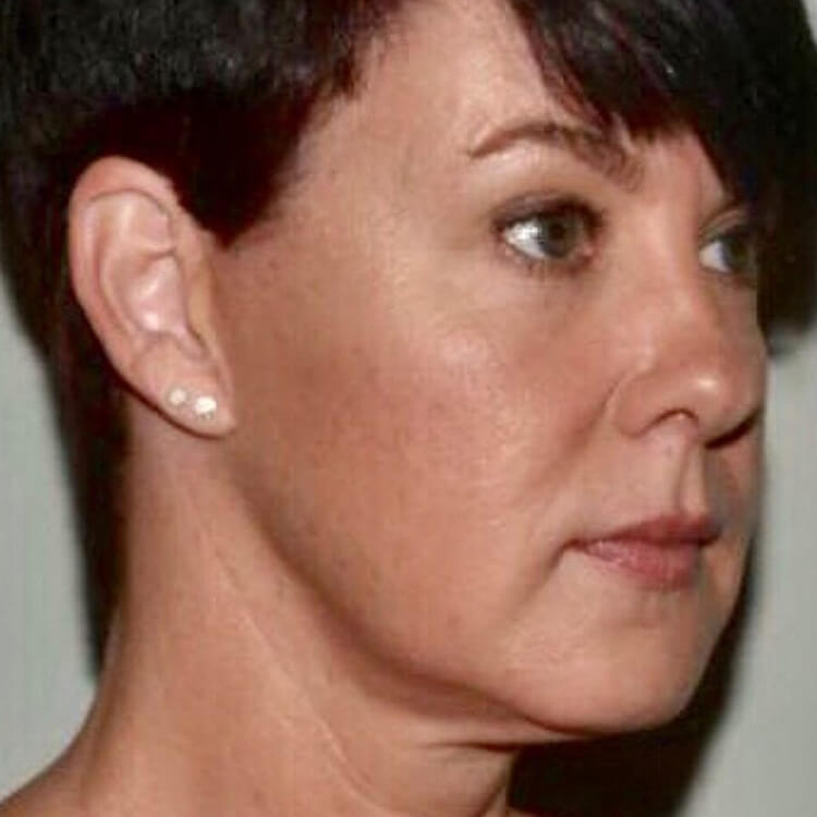 Case--3344 | After Facelift