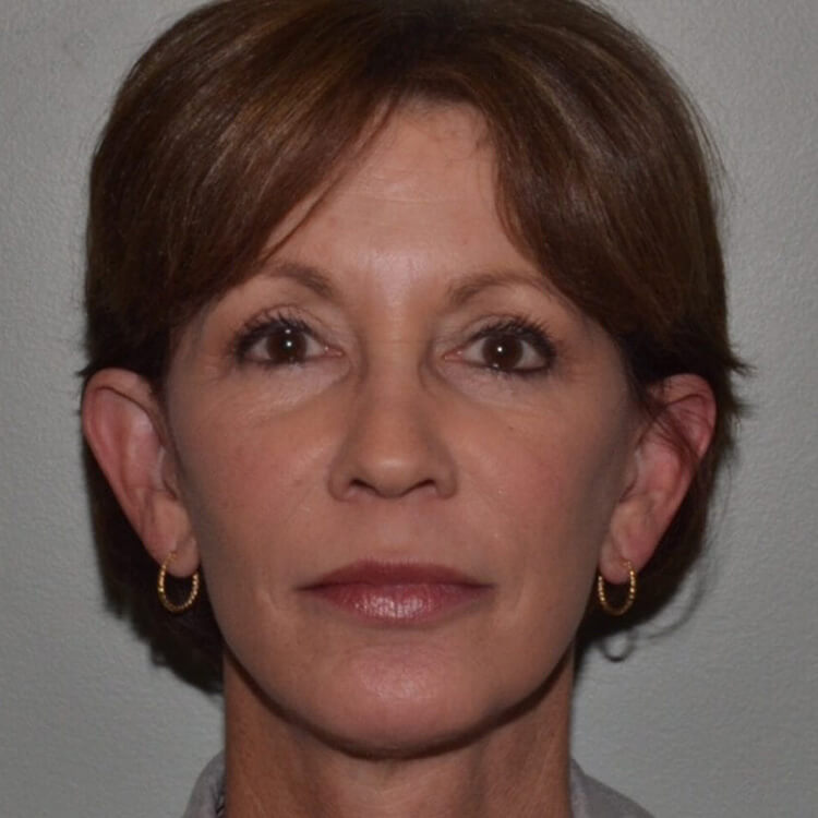 Case--4461 | After Facelift