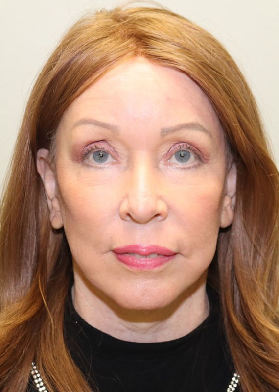 Case--4793 | After Facelift