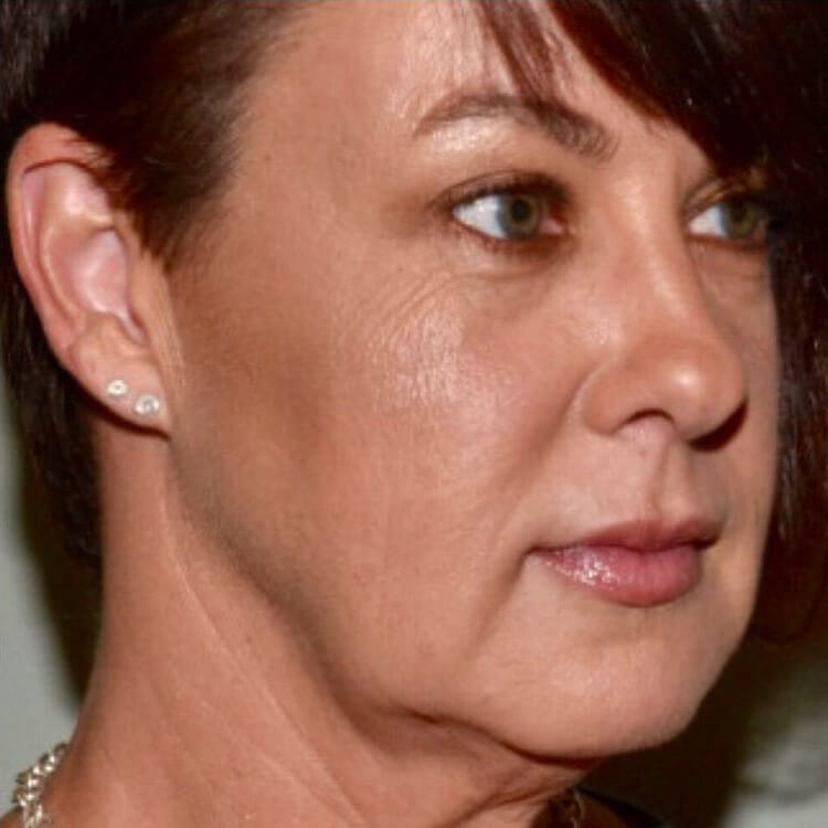 Case--3344 | Before Facelift