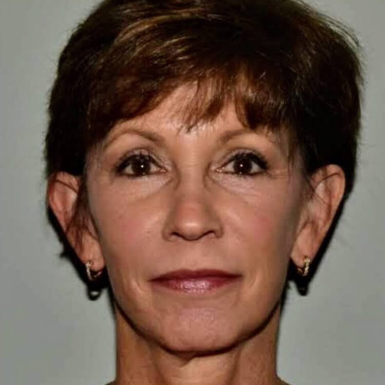 Case--4461 | Before Facelift