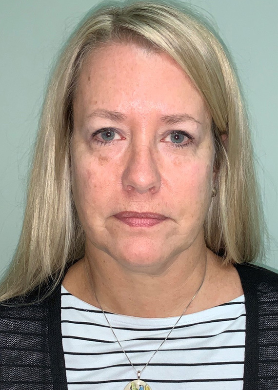 Case--8273 | Before Facelift