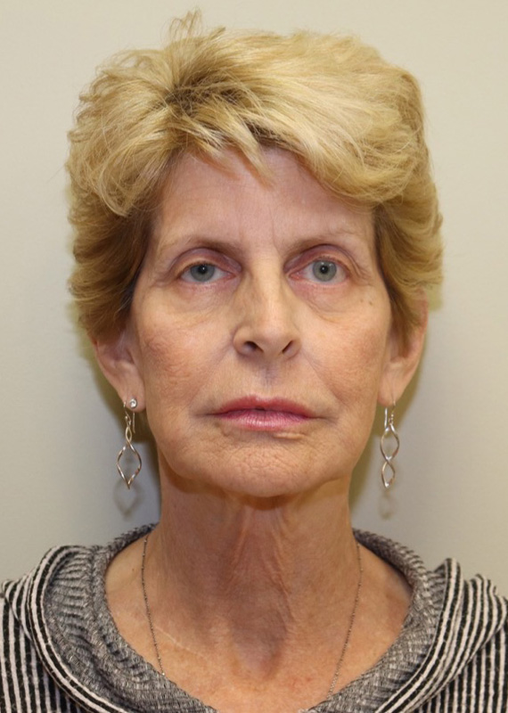 Case--1724 | Before Facelift