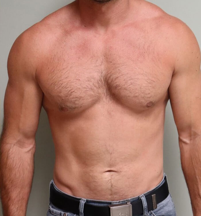 Case--7312 | After Gynecomastia