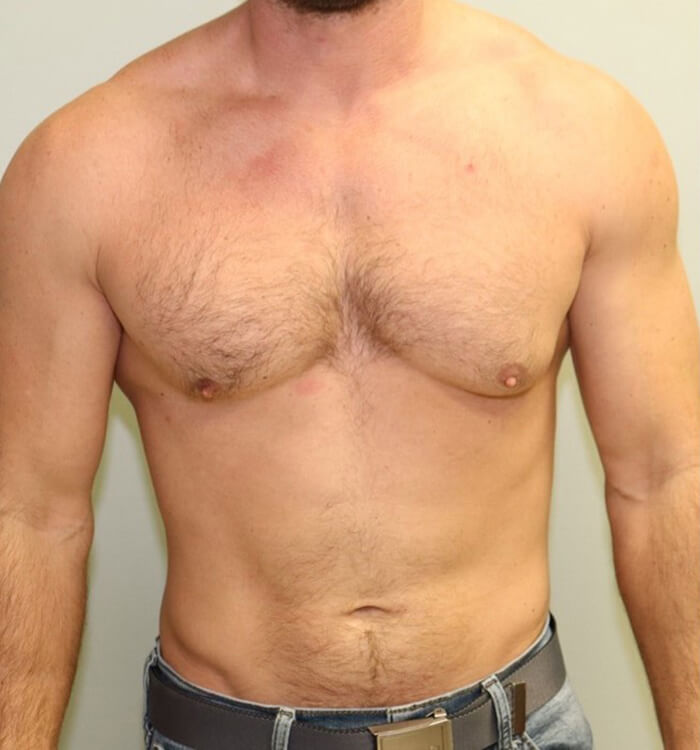 Case--7312 | Before Gynecomastia