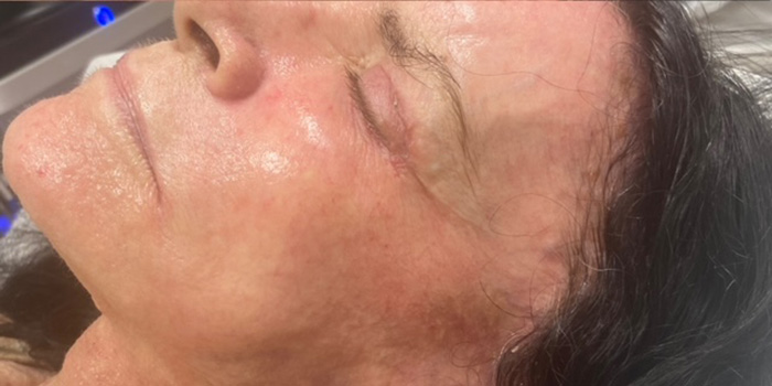 Case--4338 | After Peels, Facials and Microneedling