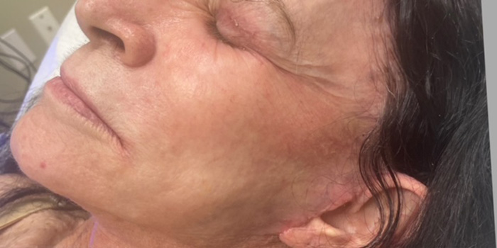 Case--4338 | Before Peels, Facials and Microneedling