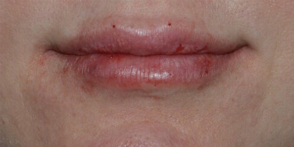 Case--1340 | After Injectables