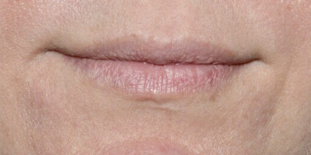 Case--1340 | Before Injectables