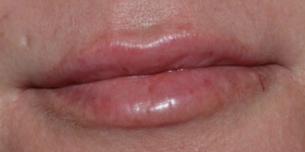 Case--7723 | After Injectables