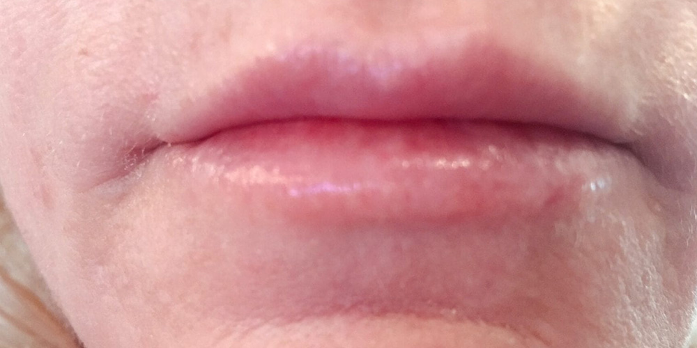 Case--2128 | After Injectables