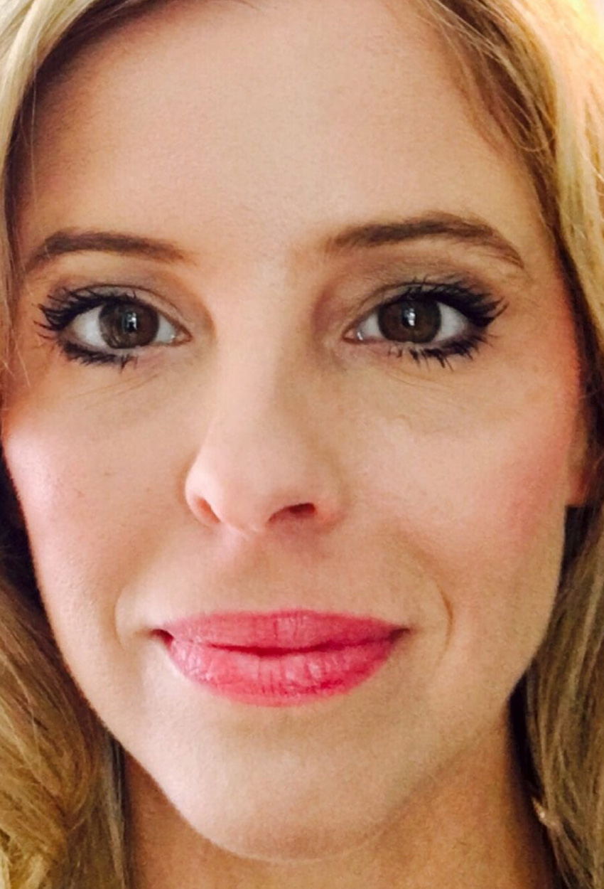 Case--3739 | After Full Face Injectables