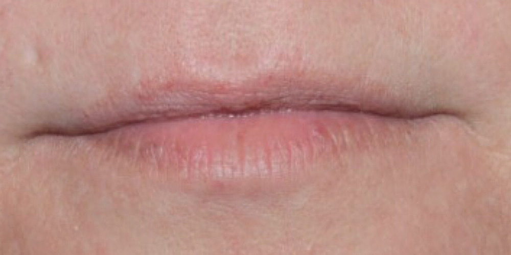 Case--7723 | Before Injectables