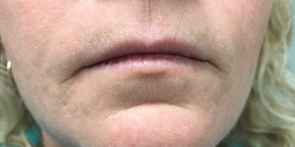 Case--2128 | Before Injectables