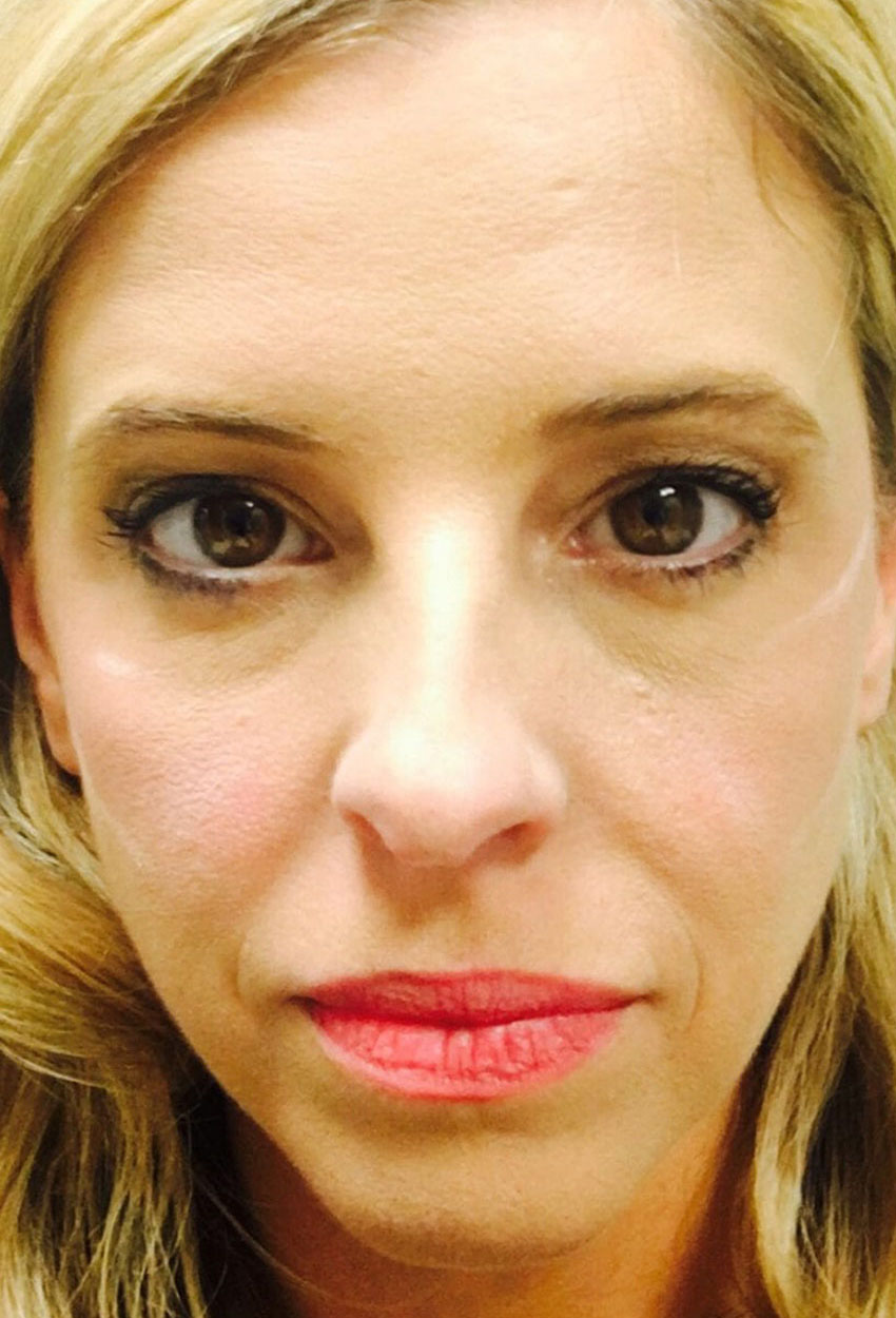 Case--3739 | Before Full Face Injectables