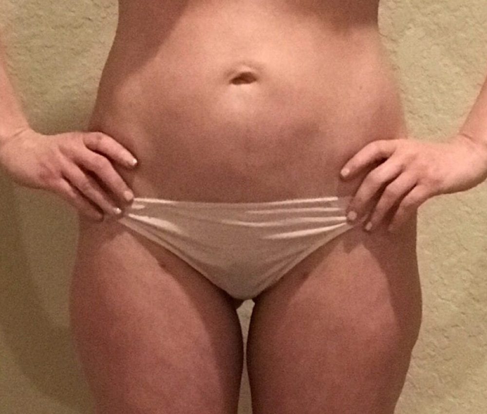 Case--7656 | After Liposuction