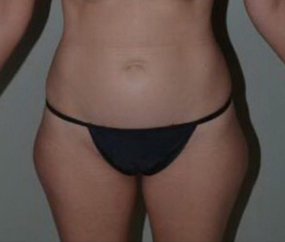 Case--7656 | Before Liposuction