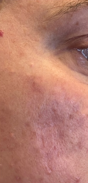 Case--3243 | After Peels, Facials and Microneedling