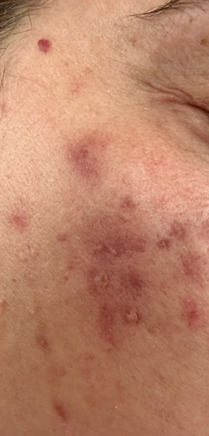 Case--3243 | Before Peels, Facials and Microneedling