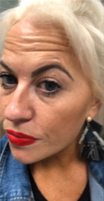 Case--5962 | Before Peels, Facials and Microneedling