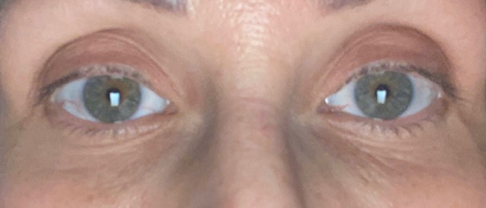 Case--1295 | Before Peels, Facials and Microneedling