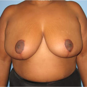 Case--8225 | After Breast Lift & Breast Reduction