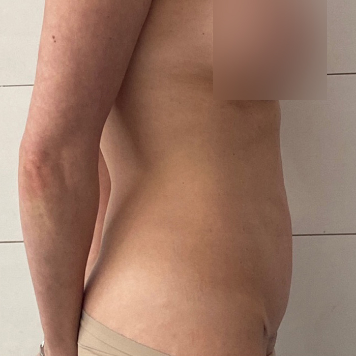 Case--3305 | After Tummy Tuck