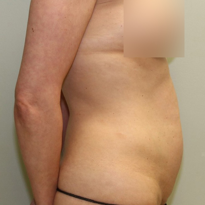 Case--3305 | Before Tummy Tuck