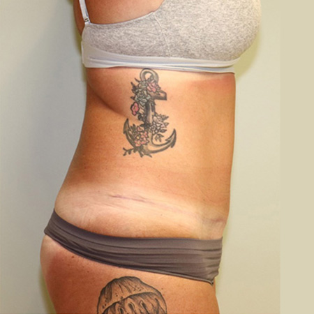 Case--8410 | After Tummy Tuck