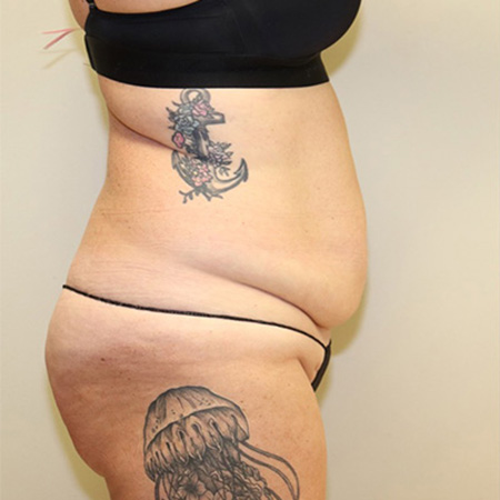 Case--8410 | Before Tummy Tuck